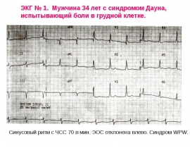 Примеры ЭКГ с расшифровкой