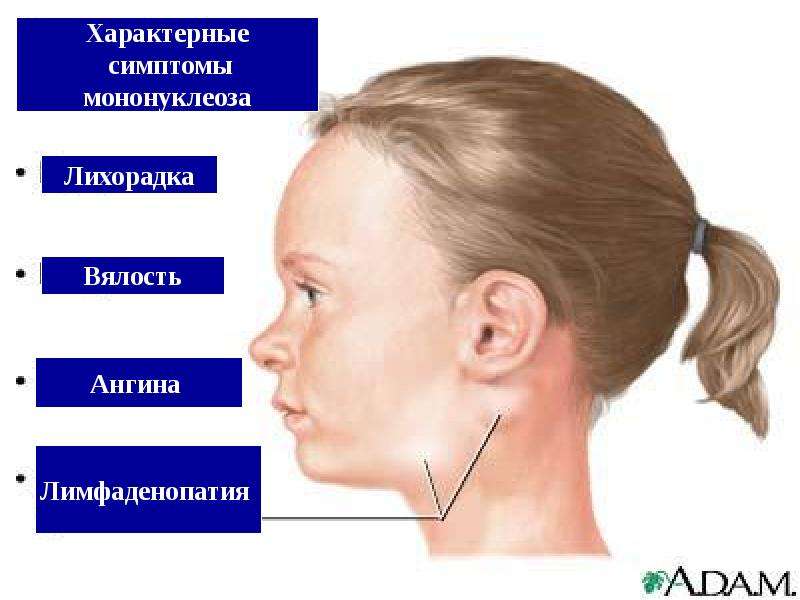 Мононуклеоз у детей картинки