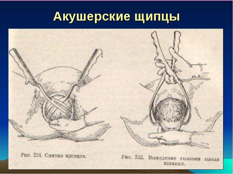 Акушерские щипцы презентация