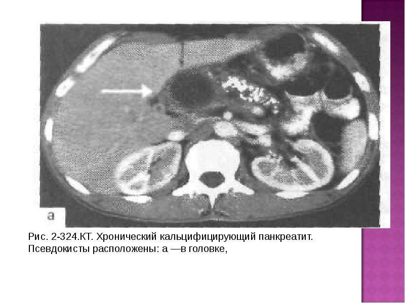 Кт картина панкреатита