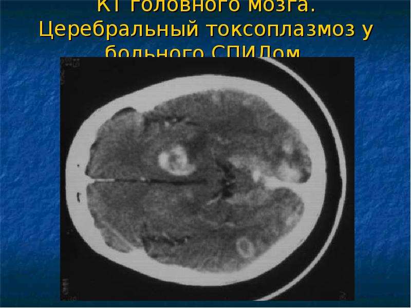 Токсоплазмоз головного мозга кт картина