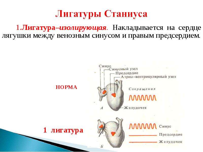 Схема наложения лигатур