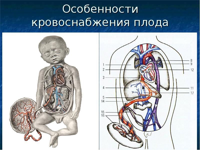 Коарктация аорты у детей презентация