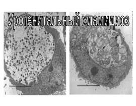Урогенитальный хламидиоз