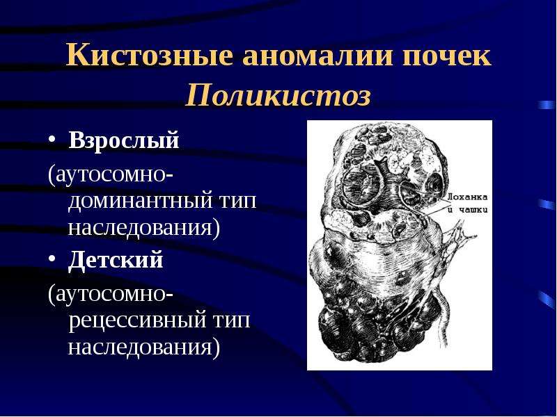 Аномалии почек презентация