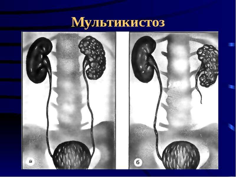 Дисплазия почки презентация