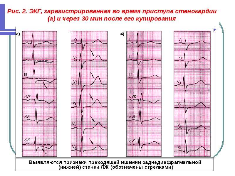 Кардиограмма при стенокардии фото