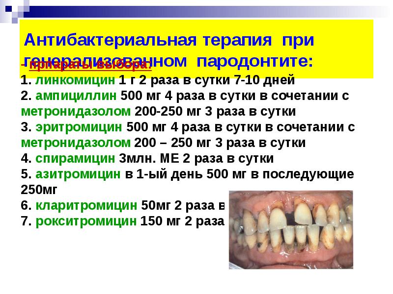 Пародонтит лекарства для лечения