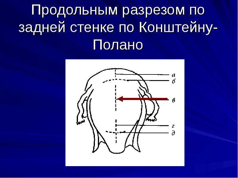 Кесарево сечение картинки