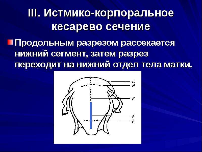 Натальная карта кесарево сечение