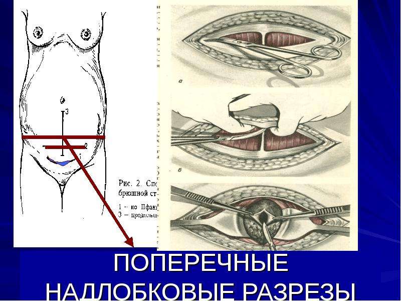 Кесарево сечение картинки