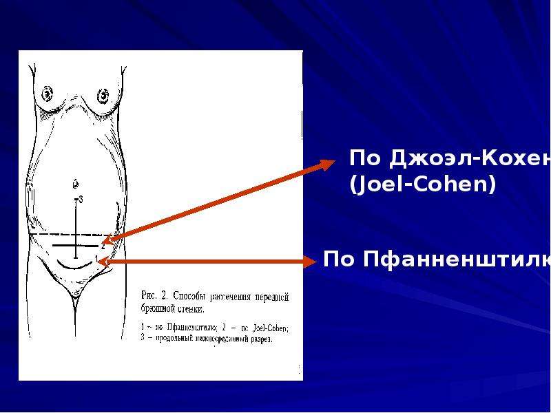 Сечение матки. Разрез по Джоэл Кохену. Разрез при кесарево сечение.