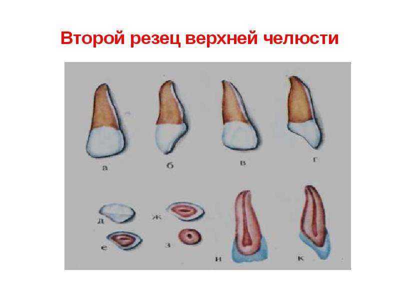 Верхних резцов. 2 Резец верхней челюсти. Латеральный резец верхней челюсти справа. Мезиалmust резец верхней челюсти. 2 Резец зуб верхней челюсти.