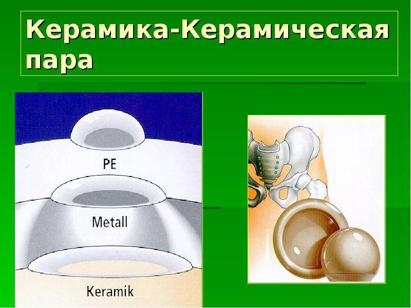 Пара трения. Пара трения керамика керамика. Биомет керамическая пара трения. Схемы эндопротезов по паре трения. Износ пары трения у эндопротезов.