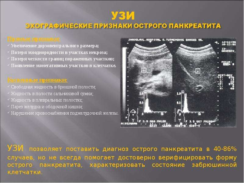 Признаки острой. Острый отечный панкреатит УЗИ. Острый панкреатит эхограммы. УЗИ диагностика хронического панкреатита. УЗИ критерии острого панкреатита.