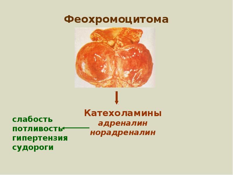 Феохромоцитома презентация по эндокринологии