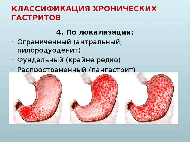 Хронический гастрит презентация