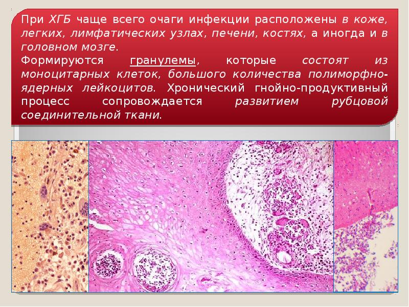 Патология фагоцитоза, слайд 25