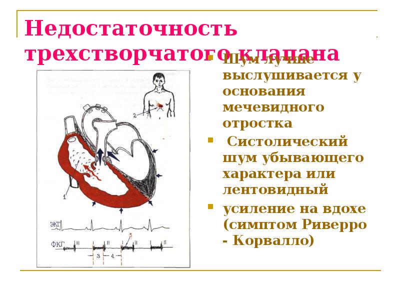 Недостаточность трикуспидального клапана презентация