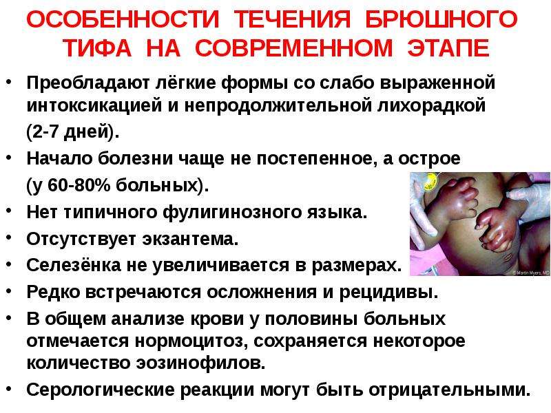 Язык при брюшном тифе фото