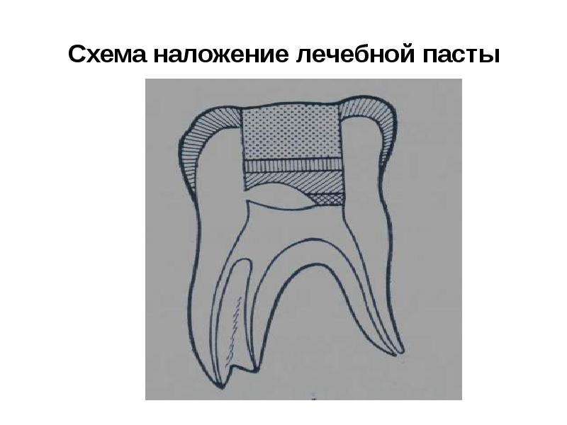 Схема наложения лечебных прокладок