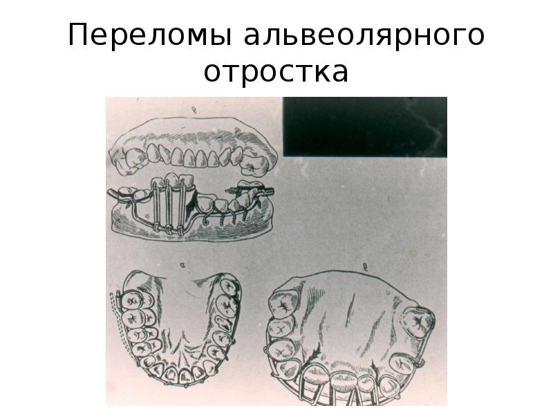 Область альвеолярного отростка верхней челюсти. Перелом альвеолярных отростков зуба. Перелом альвеолярного отростка классификация. Перелом альвеолярного отростка. Пеплом альвеолярнрго отростка.