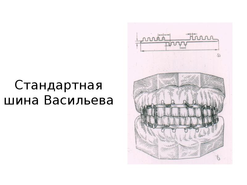 Переломы челюстей стоматология презентация