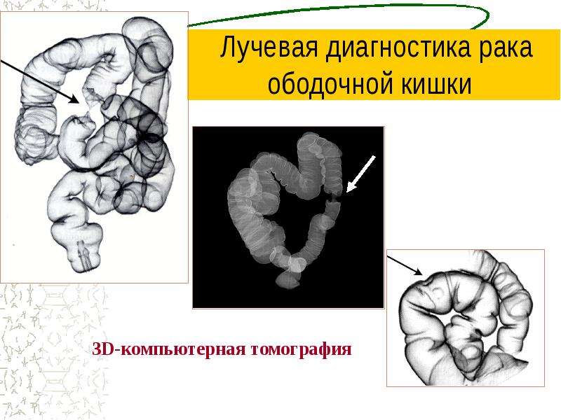 Рак ободочной кишки презентация