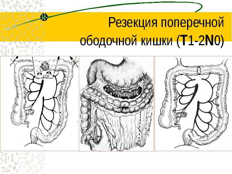 Поперечно ободочная кишка. Опухоль поперечно-ободочной кишки. Резекция поперечной ободочной. Сегментарная резекция ободочной. ЗНО поперечной ободочной кишки t3nomo2a.