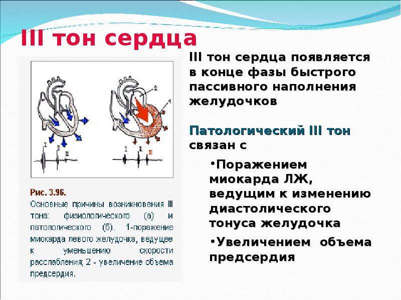 2 тон сердца возникает