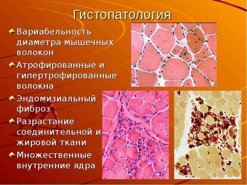 Фиброз тканей. Разрастание соединительной ткани. Фиброз мышечных волокон. Фиброзная соединительная ткань. Фиброзно-жировая ткань что это.