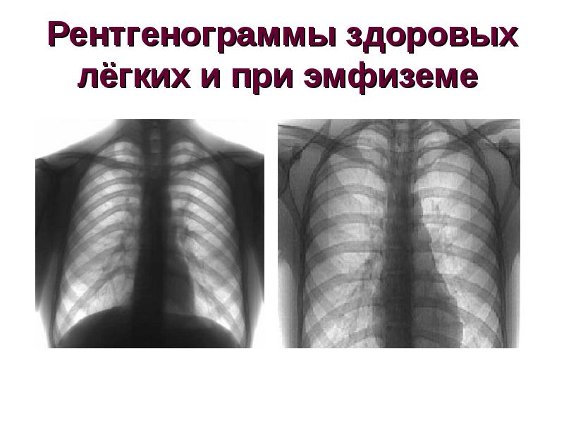 Рентгенологическая картина при хобл