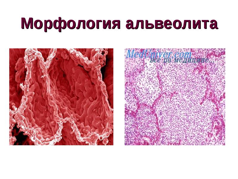 Синдром хаммена рича презентация у детей