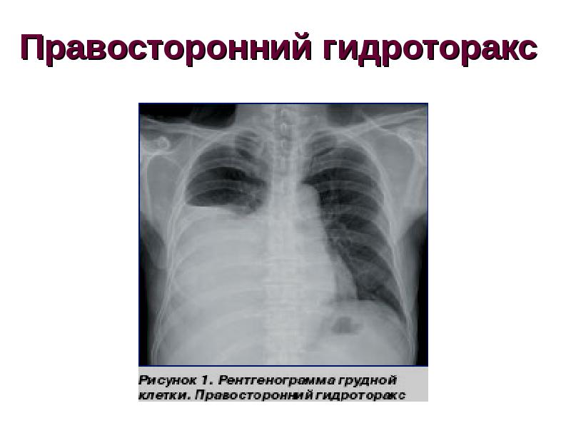 Правосторонний гидроторакс легкого. Гидроторакс легкого рентген. Правосторонний гидроторакс рентген. Рентген грудной клетки гидроторакс. Тотальный левосторонний гидроторакс рентген.