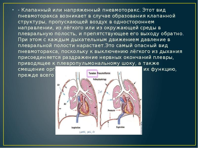 Клапанный пневмоторакс презентация