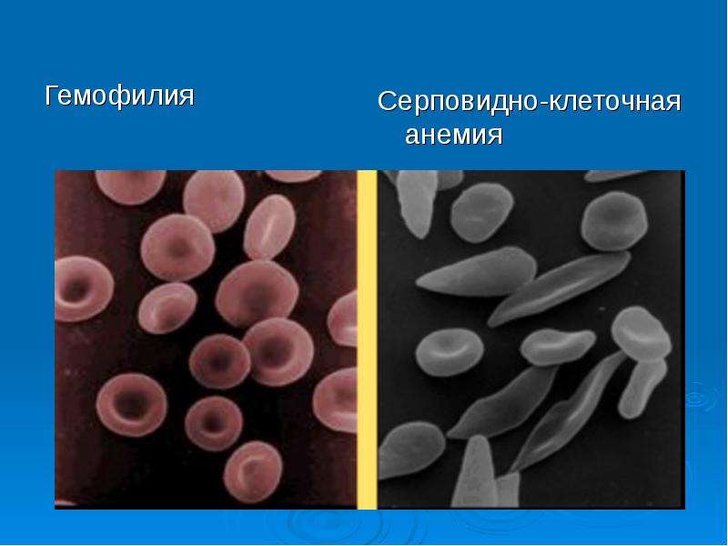 Серповидно клеточная заболевание. Серповидная анемия эритроциты. Эритроциты при серповидноклеточной анемии. Серповидноклеточная анемия гемолиз. Серповидноклеточная анемия симптомы.