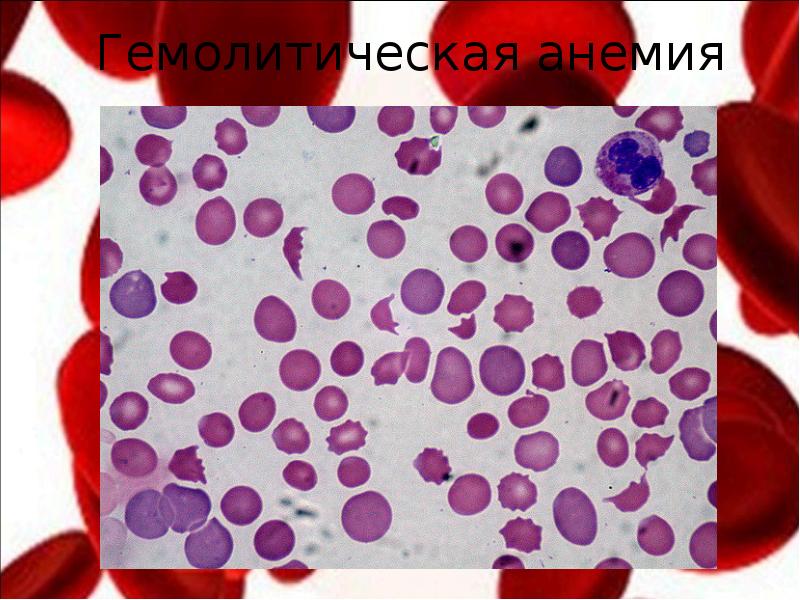 Приобретенная гемолитическая анемия картина крови. Малокровие 6