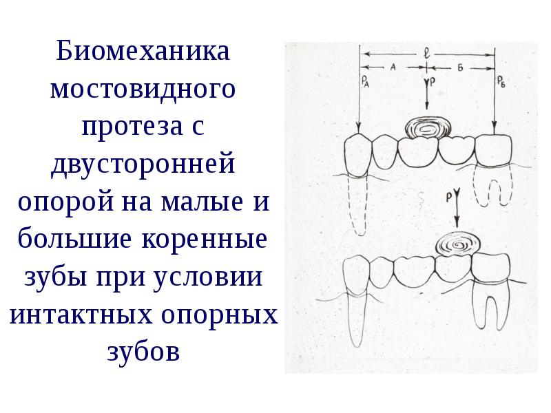 Части мостовидного протеза