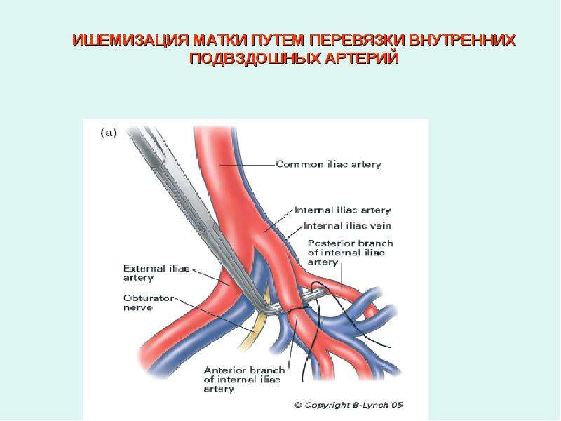 Правая подвздошная артерия. Перевязка внутренних подвздошных артерий Акушерство. Перевязка внутренней подвздошной артерии техника. Ишемия подвздошной артерии. Операция подвздошной артерии.