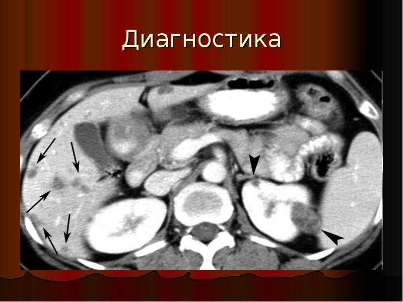 Диагностика 23. Урогенитальный туберкулез презентация. Туберкулез исторический аспект. Диагноз l23.