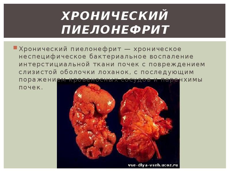 Хронический пиелонефрит Хронический пиелонефрит — хроническое неспецифическое бактериальное воспален