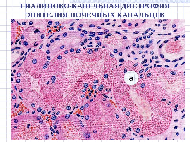 Дистрофия почек фото