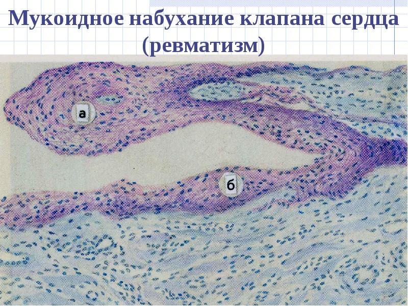 Рисунок зернистая дистрофия