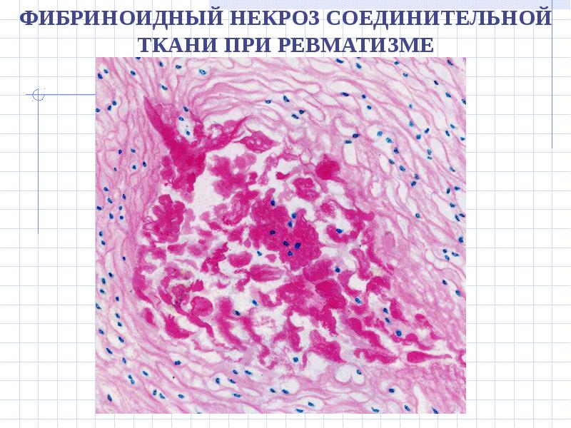 Фибриноидное набухание это. Фибриноидное набухание патанатомия. Фибриноидное набухание соединительной ткани микропрепарат. Фибриноидное набухание и некроз соединительной ткани при ревматизме. Фибриноидное набухание гистология.