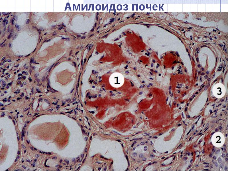 Дистрофия почек фото