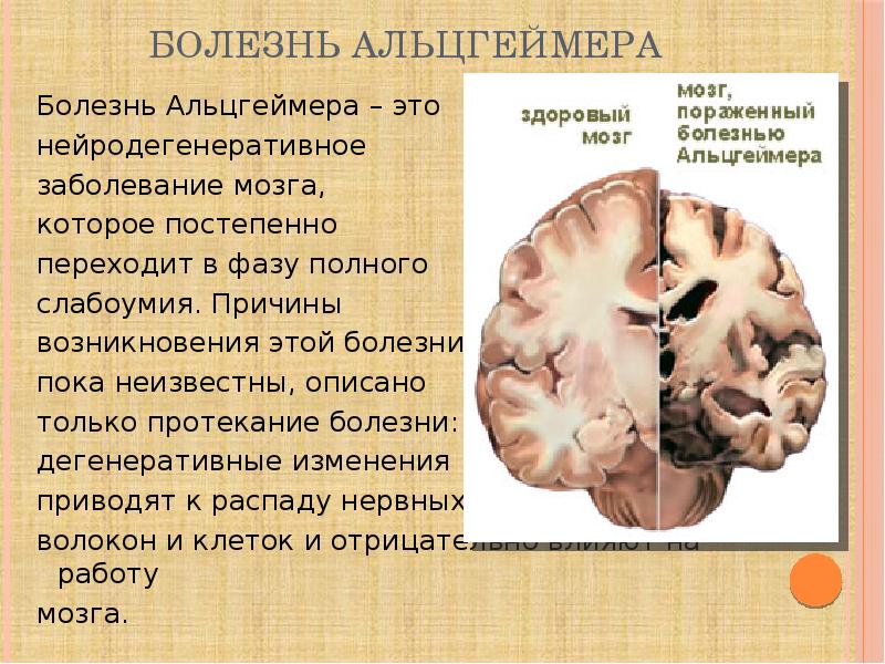 Болезнь Альцгеймера Болезнь Альцгеймера – это нейродегенеративное заболевание мозга, которое постепе