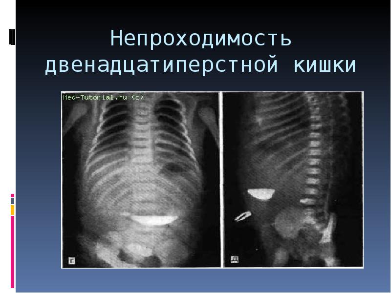 Врожденная и приобретенная кишечная непроходимость у детей презентация