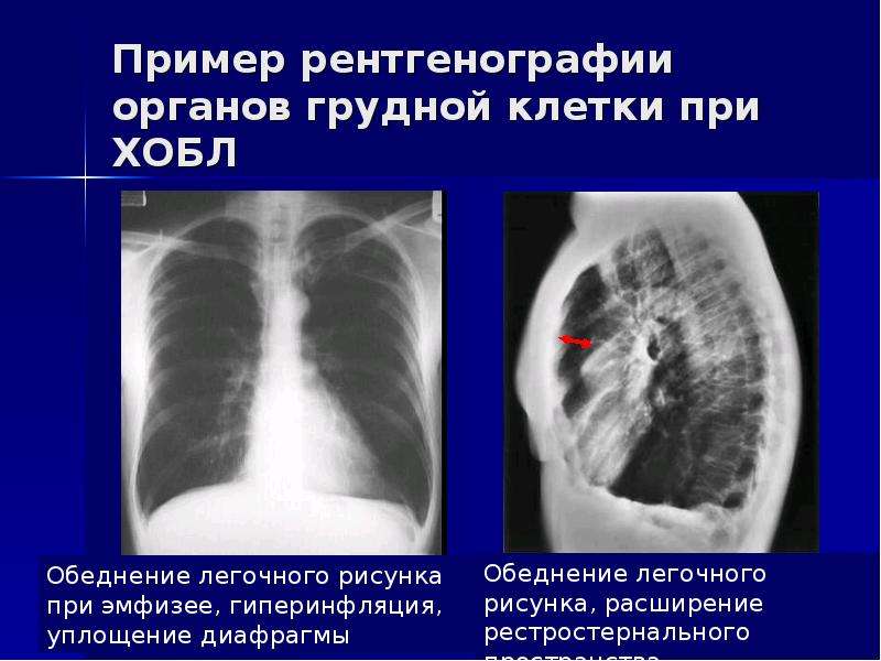 Рентгенологическая картина при хобл