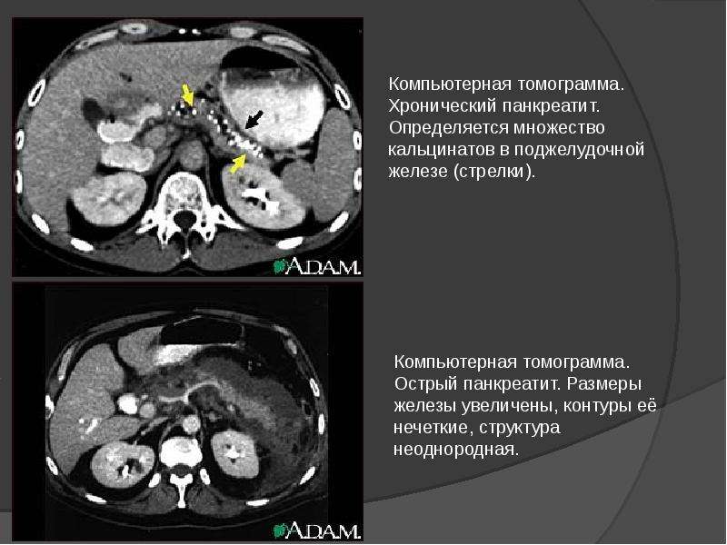 Кт признаки поджелудочной железы. Кальцификация поджелудочной железы кт. Множественные кальцинаты поджелудочной железы кт. Кальциноз поджелудочной железы кт. Кальцинаты поджелудочной железы кт.