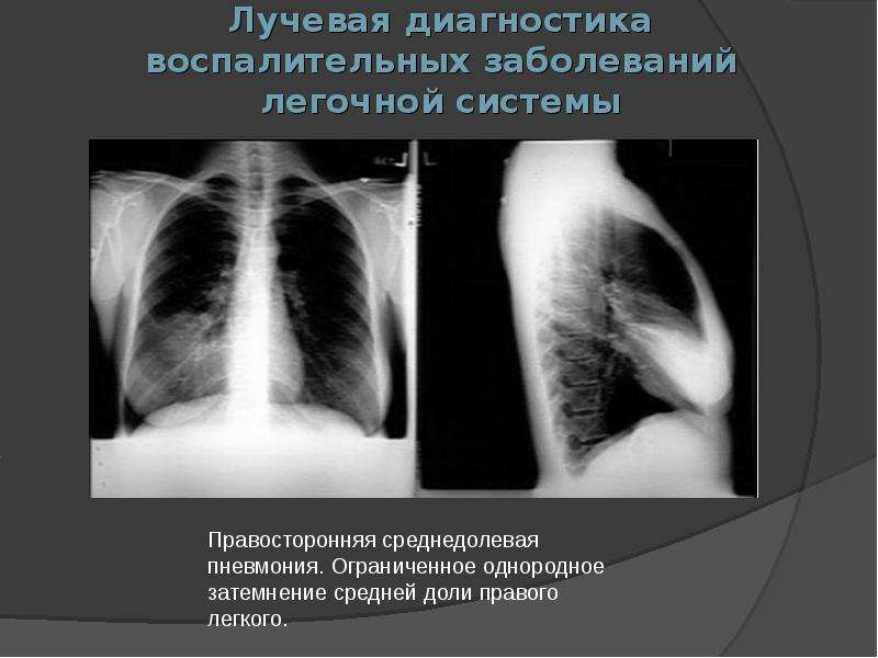 Правая пневмония. Рентген правосторонней среднедолевой пневмонии. Среднедолевая пневмония рентген. Пневмония средней доли правого легкого рентген. Пневмония рентген лучевая диагностика.